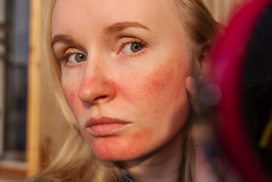 Rosacea Ernährung Tabelle